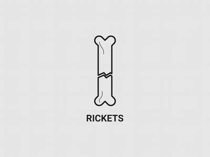 Rickets Symptoms, Causes and Treatment